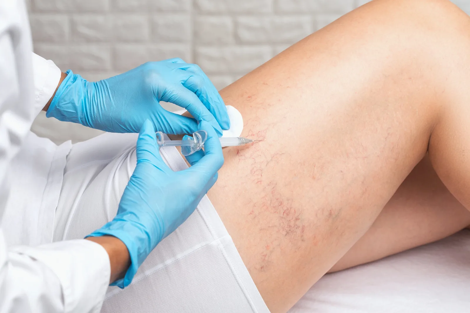 Can Endermologie Reduce the Appearance of Varicose Veins?