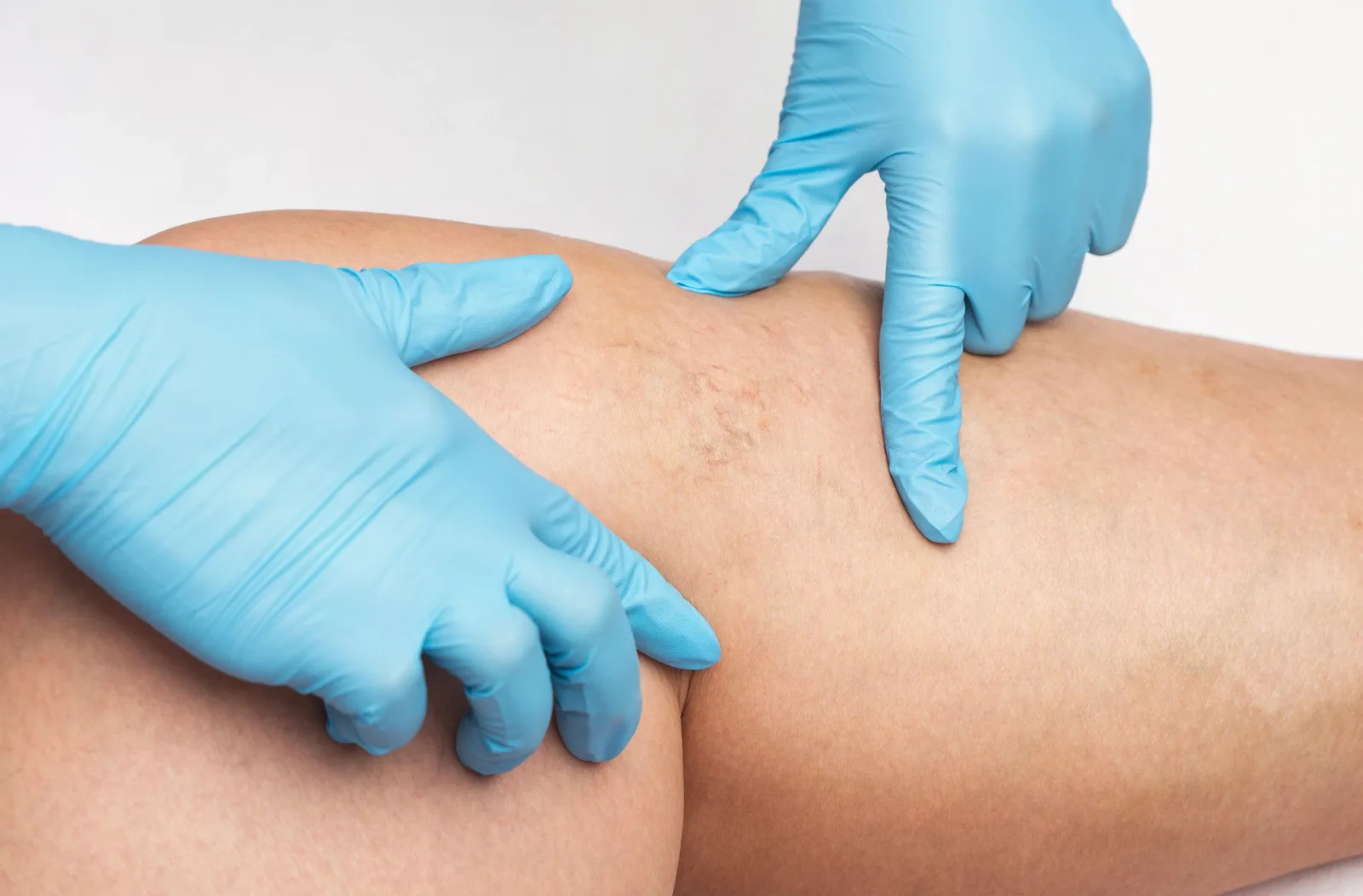 Do Spider Veins Hurt When Leg Pressed?