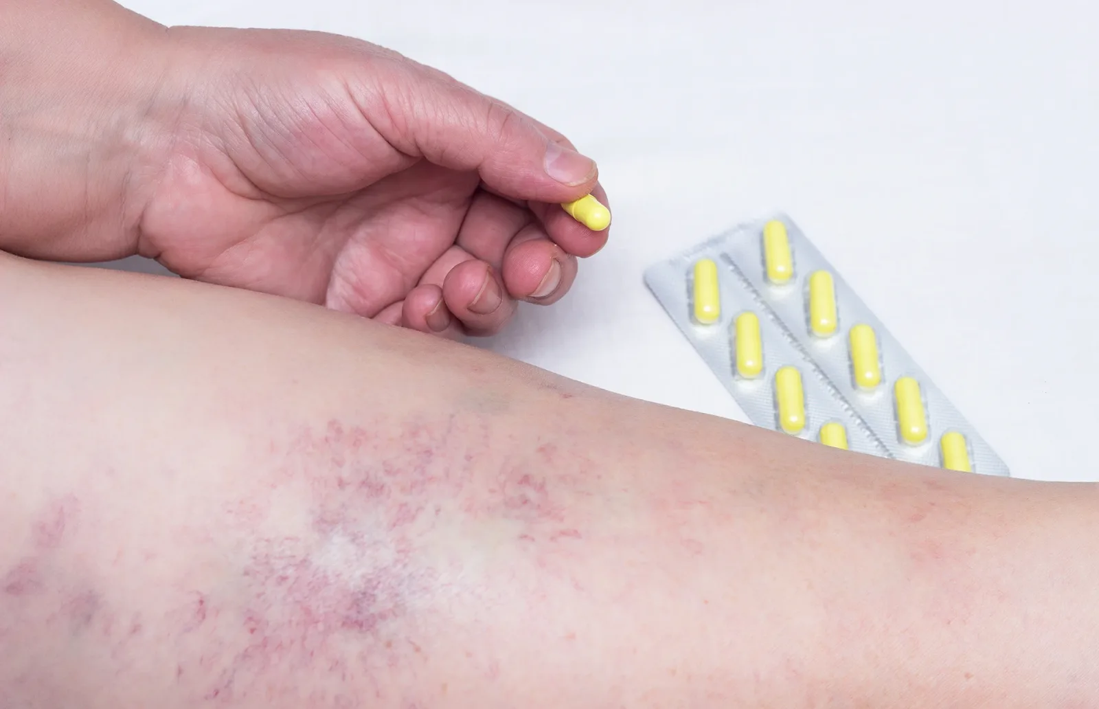 Does Mefenamic Acid Work Against Varicose Veins?