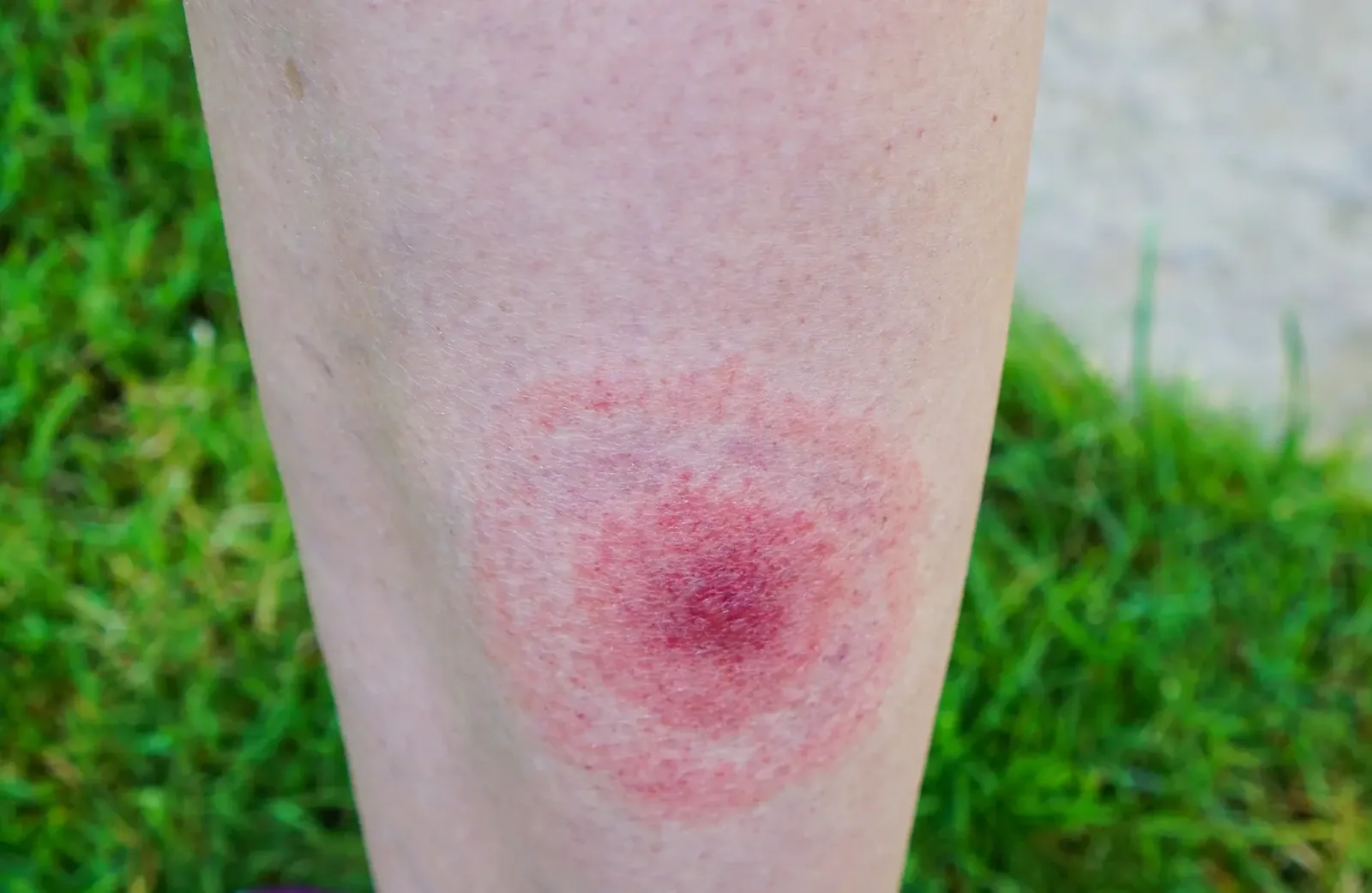 Can Lyme Disease Cause Spider Veins?