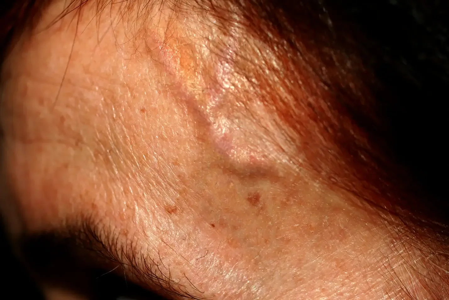 Spider Veins on Temples: Causes, Treatment Options, and