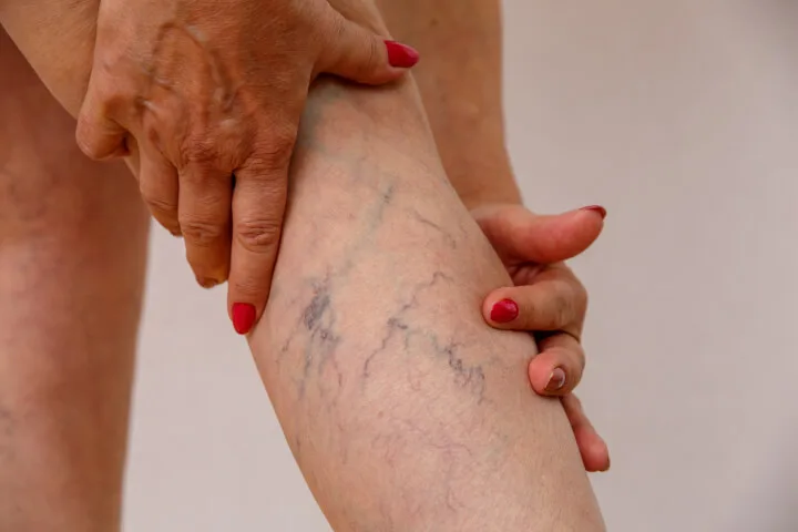 Can Varicose Veins Cause Blood Clots?
