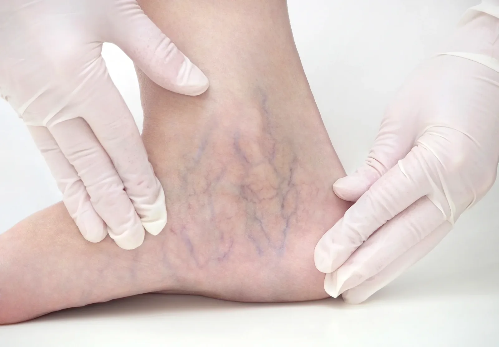 Venous Malformations in Children: Early Signs Parents