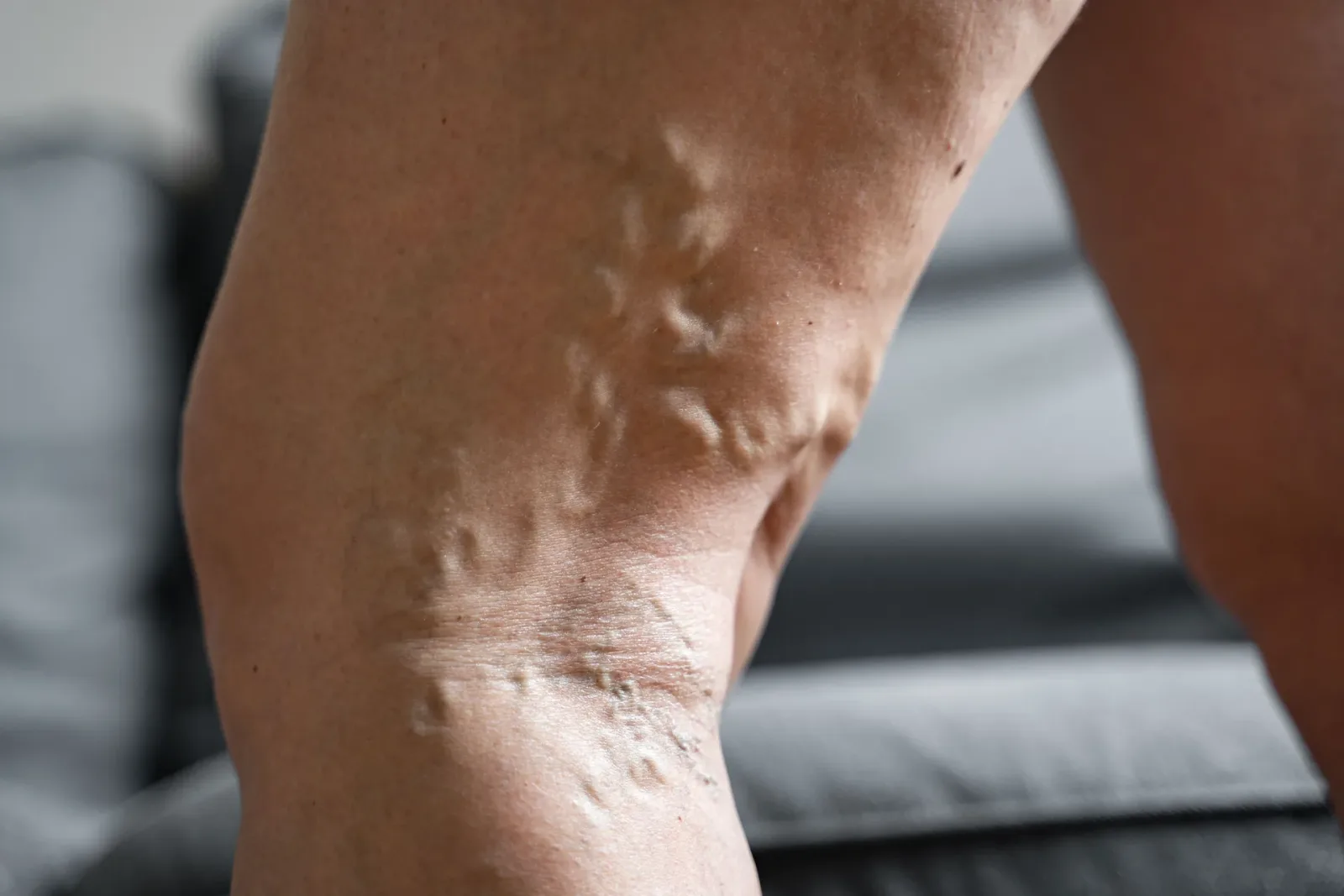Varicose vein duplex ultrasound exam at Vein Center Doctor